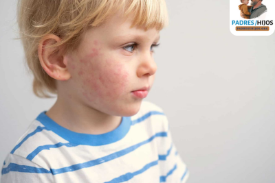 Alergias en niños: Síntomas, tratamientos y cuidados