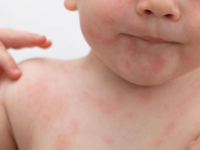 Alergias en niños