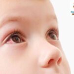Conjuntivitis en niños: causas, síntomas y tratamiento